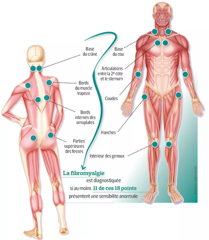 Illustration des 18 points de contrôle de la fibromyalgie, par Le Figaro infographies